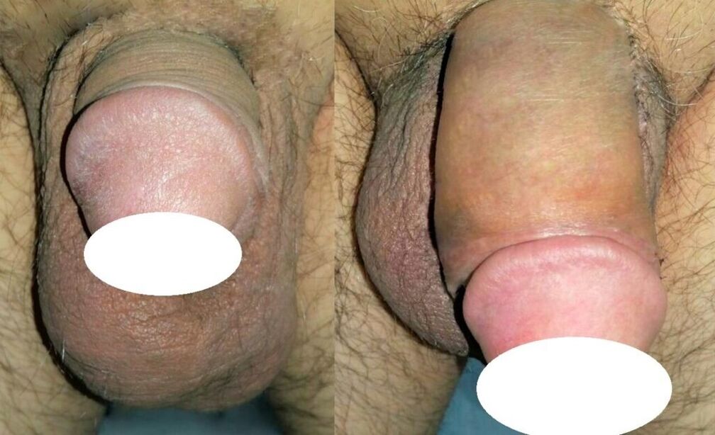 Photos avant et après agrandissement du pénis.